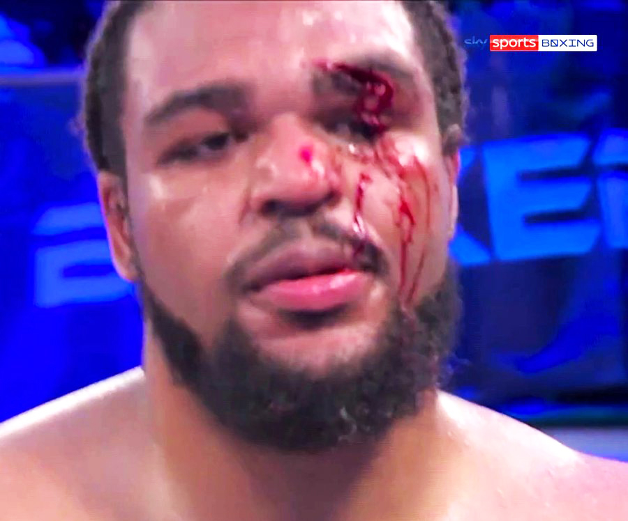 Brit boxing up-and-comer Jamie TKV left covered in blood with gruesome eye injury in brutal shock loss to late stand-in