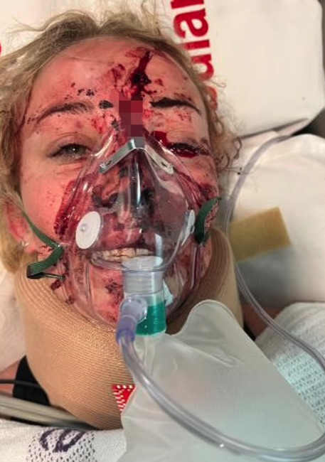 Teen motocross rider narrowly escapes death after shattering face in horror crash that saw her helmet filled with blood