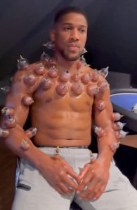 Anthony Joshua leaves fans wincing as he shares video of bizarre ‘hot cupping’ treatment