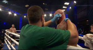 Horror moment Anthony Joshua’s former opponent left with ear HANGING OFF after nasty injury in Bare Knuckle fight