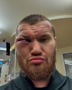 Giant 18 stone heavyweight looks unrecognisable as he shows off horror eye injury from ‘multiple head blows’ in fight