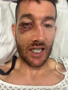 Rugby star facing ‘numb face for rest of his life’ after sickening injury left him with 11 fractures in his face