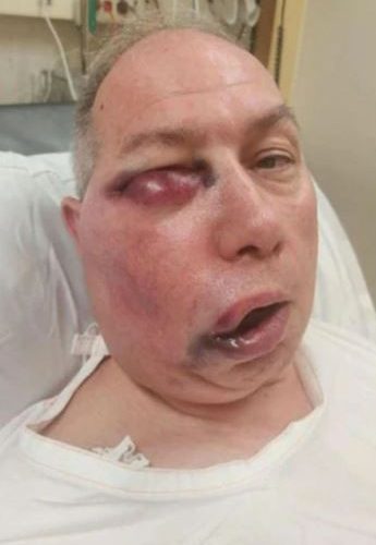 Cricket umpire left unrecognisable after horror facial injuries but says he ‘feels like he won lottery’