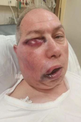 Cricket umpire left unrecognisable after horror facial injuries but says he ‘feels like he won lottery’