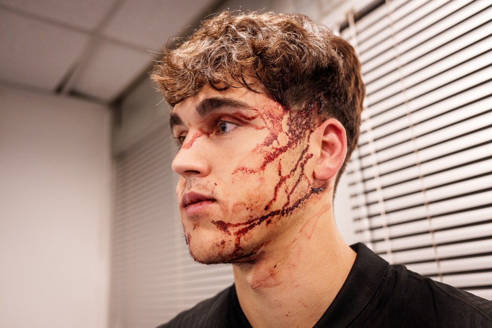 Barcelona star Pau Cubarsi shows off horror facial injuries after sickening kick to face left him needing 10 stitches