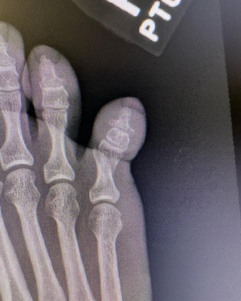 Golf star Viktor Hovland suffers freak bedroom injury as he shares X-ray picture